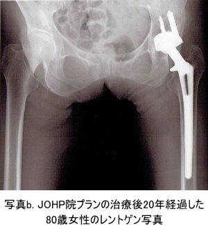 股関節のインプラント治療ｂ　画像
