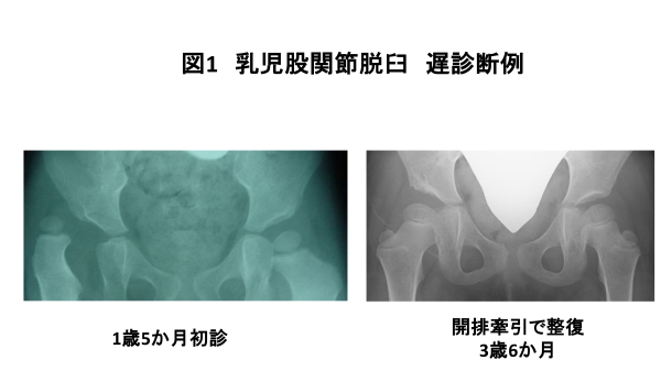 図1　乳児股関節脱臼　遅診断例　画像