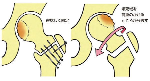 大腿骨骨頭壊死症に対する大腿骨頭回転骨切り術　画像