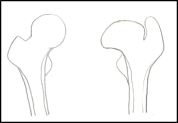 左図が正常の股関節で、右図楕円形の扁平骨頭と大転子高位を示すレントゲン像である。