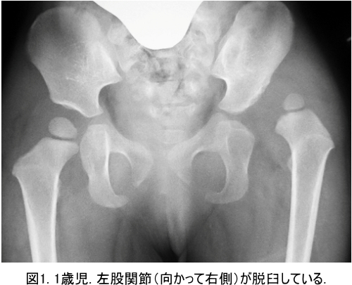 1歳児の左股関節脱臼　図　ヒップジョイントコラム