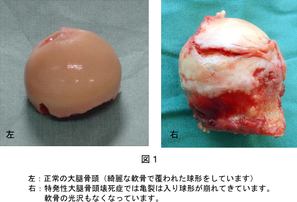 図１.　左：正常の大腿骨頭（綺麗な軟骨で覆われた球形をしています）　画像