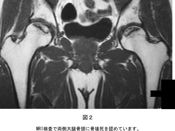 股関節 難病