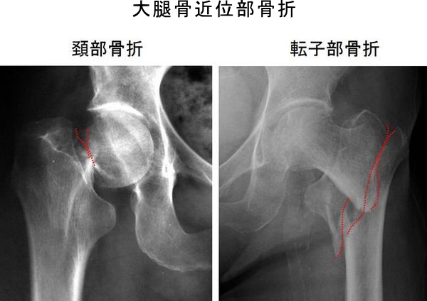 大腿骨近位部骨折　レントゲン写真　画像