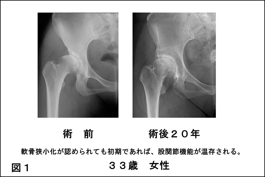 第44回hipjointコラム 変形性股関節症 寛骨臼 臼蓋 形成不全に起因する をふりかえって 帖佐悦男 宮崎大学医学部整形外科教授 公益財団法人 日本股関節研究振興財団