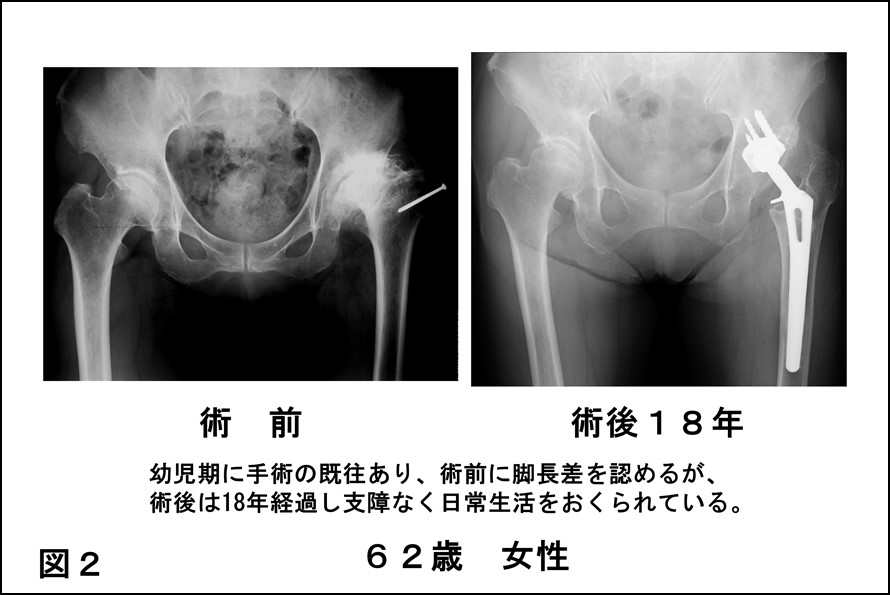 62歳女性　左変形性股関節症　幼児期に手術の既往あり　著明な脚長差も認めるが、術後18年経過し、支障なく日常生活をおくられている。画像