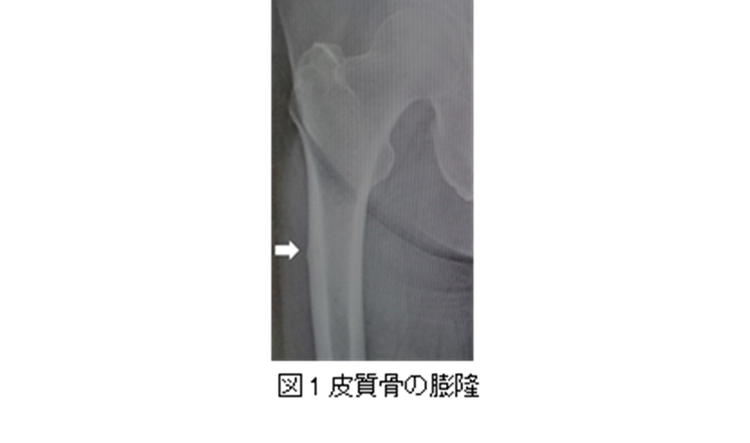 図1皮質骨の膨隆