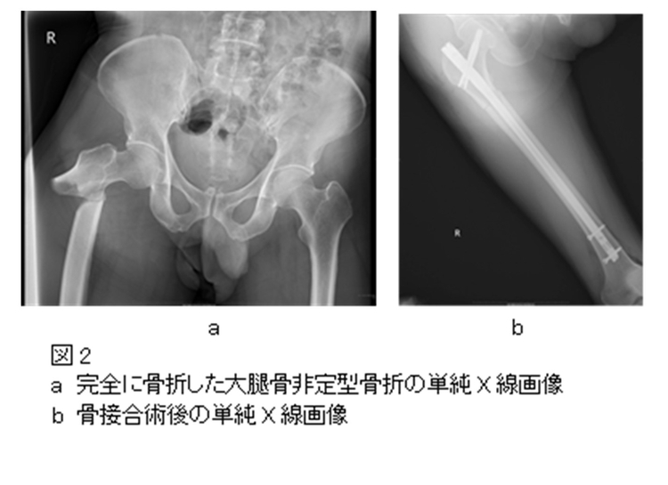 図2<br />
a　完全に骨折した大腿骨非定型骨折の単純X線画像<br />
b　骨接合術後の単純X線画像