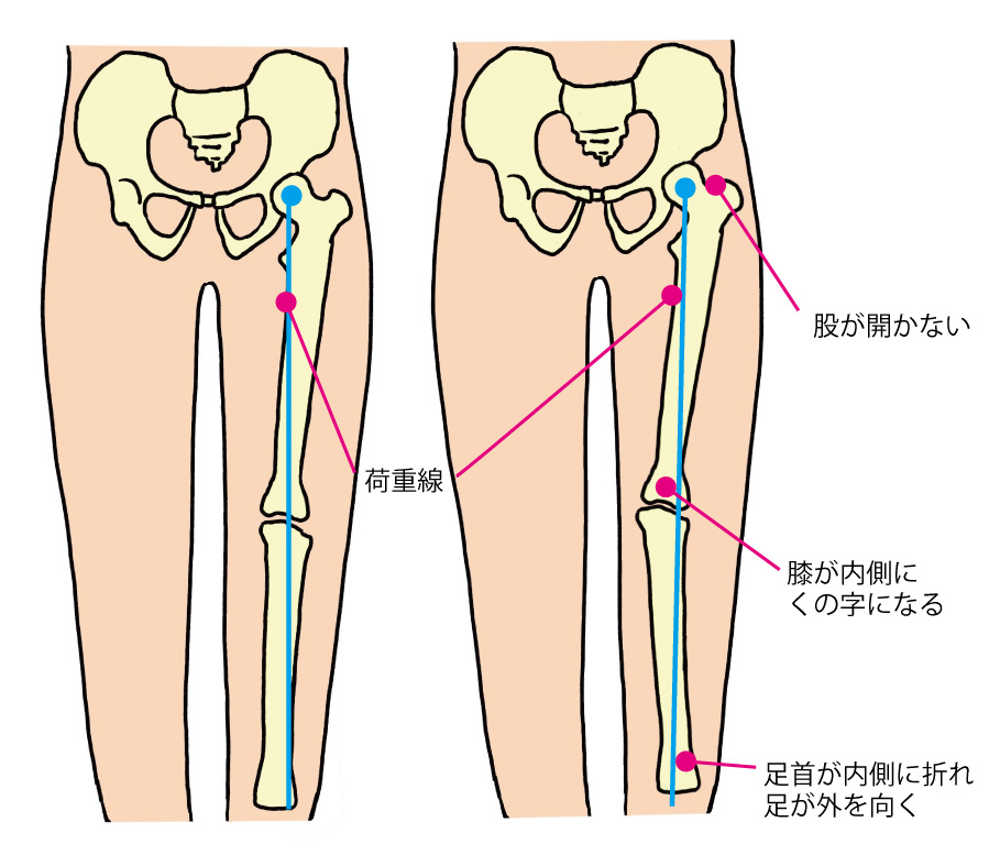 跛行 トレン デレン ブルグ