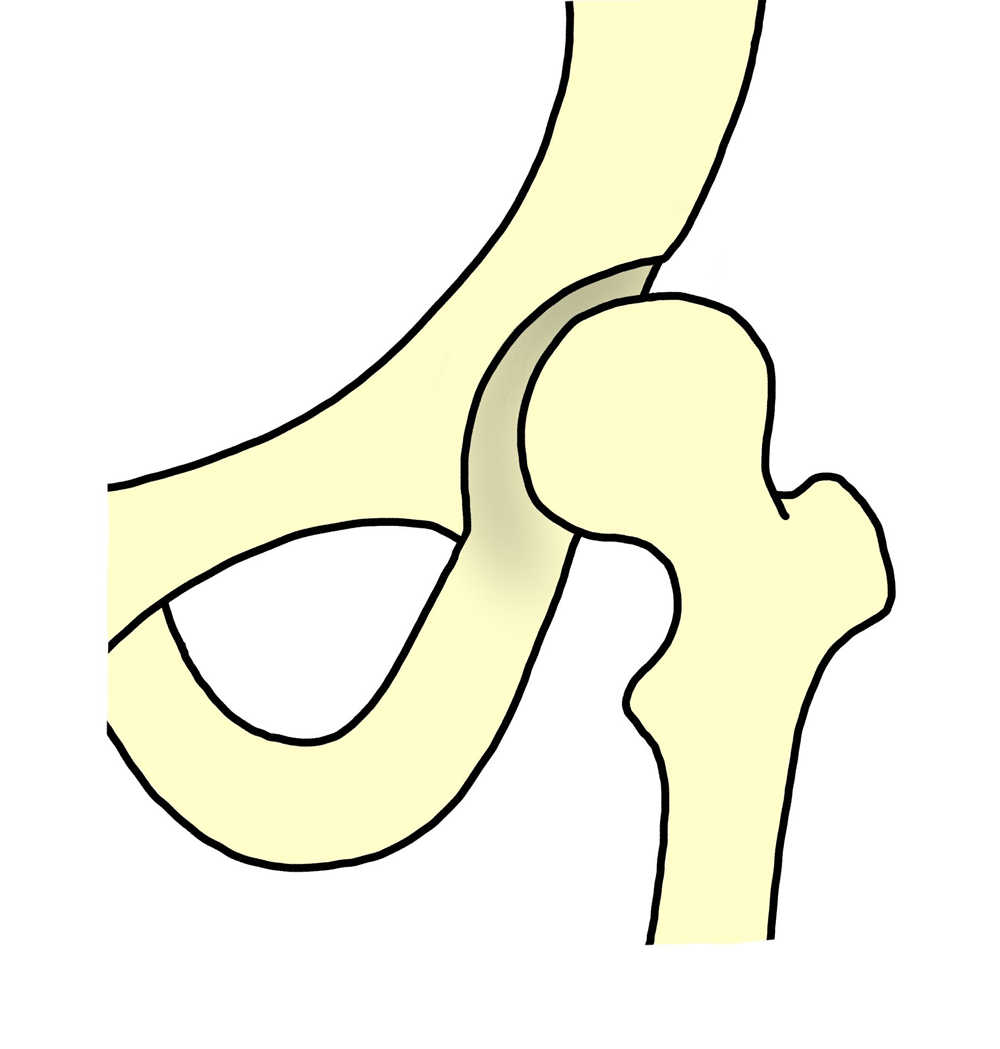 前股関節症