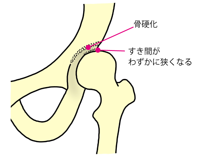 初期股関節症