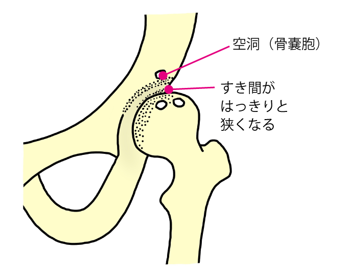 進行期股関節症