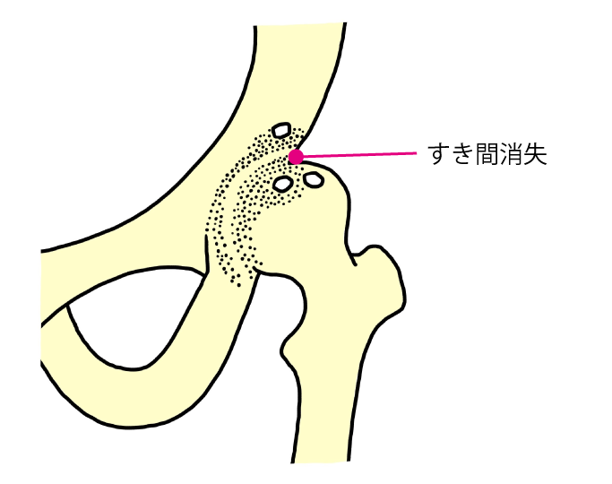 末期股関節症