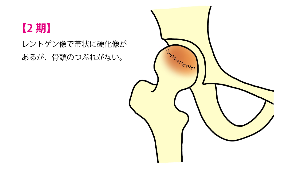 【2期】レントゲン像で帯状に硬化像があるが、骨頭のつぶれがない。