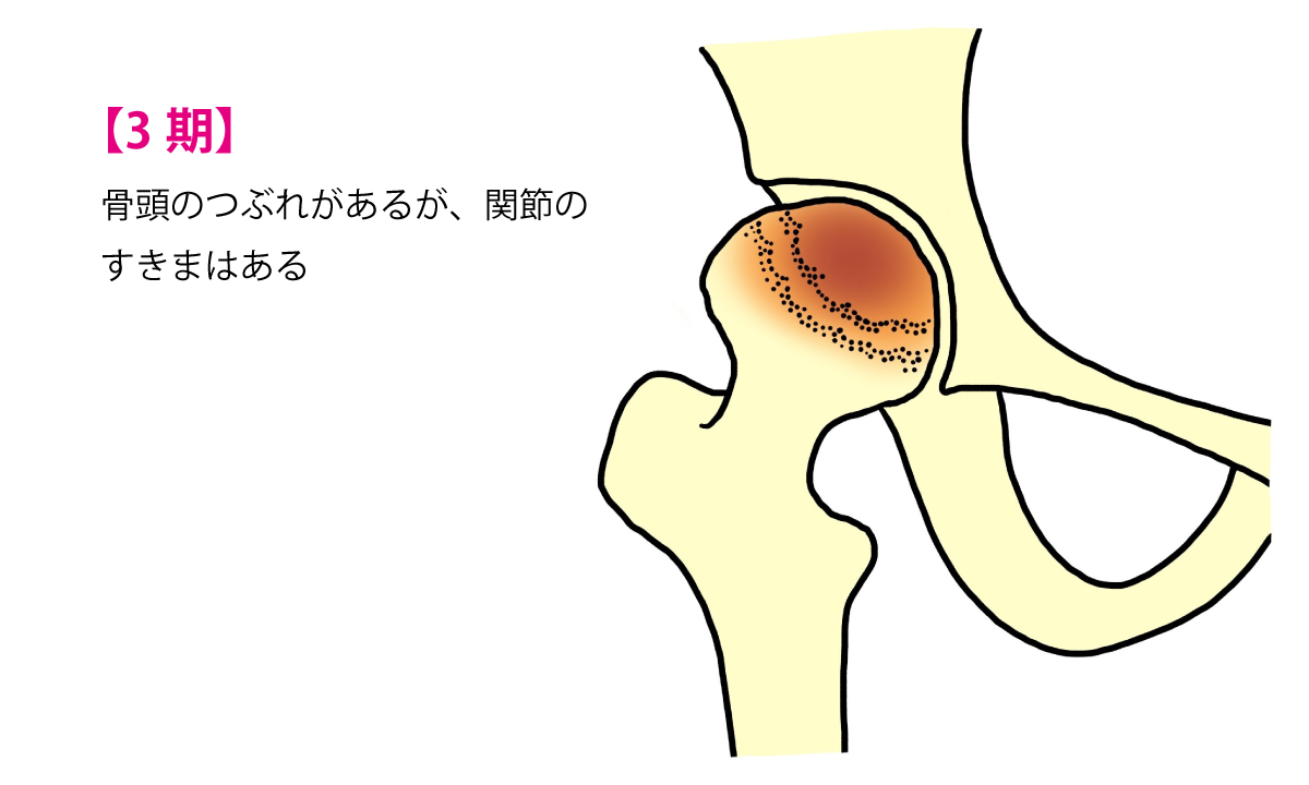 【3期】骨頭のつぶれがあるが、関節のすきまはある。