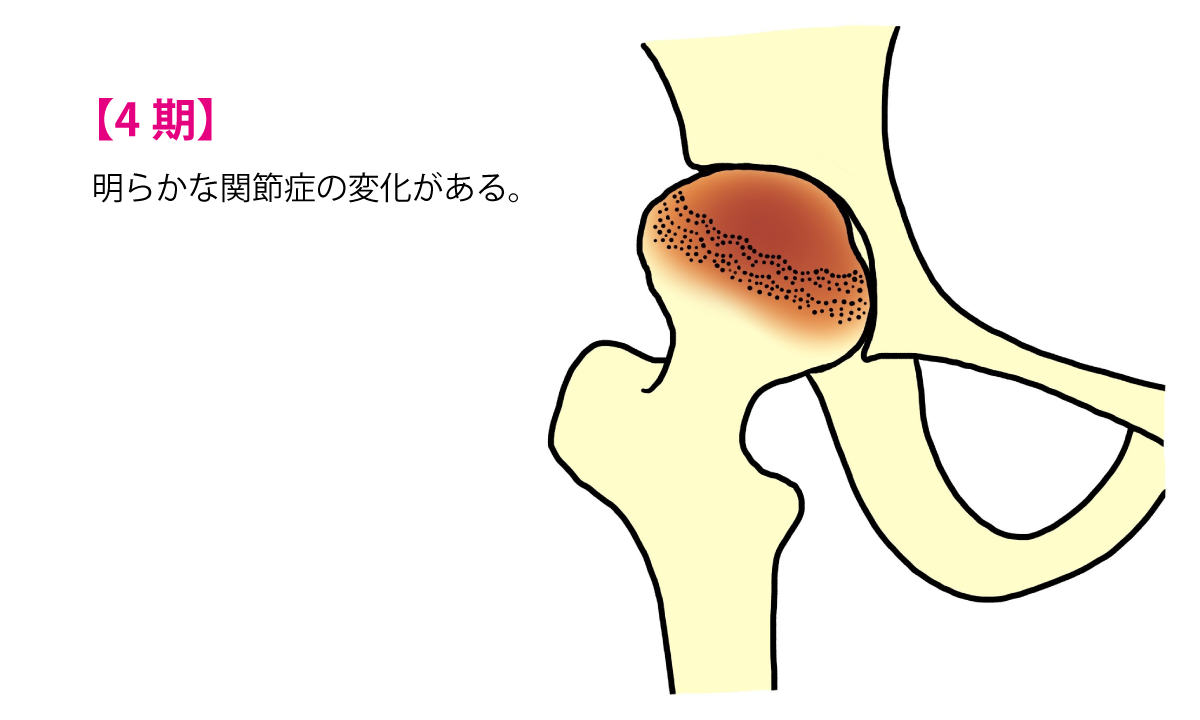 【4期】明らかな関節症の変化がある。