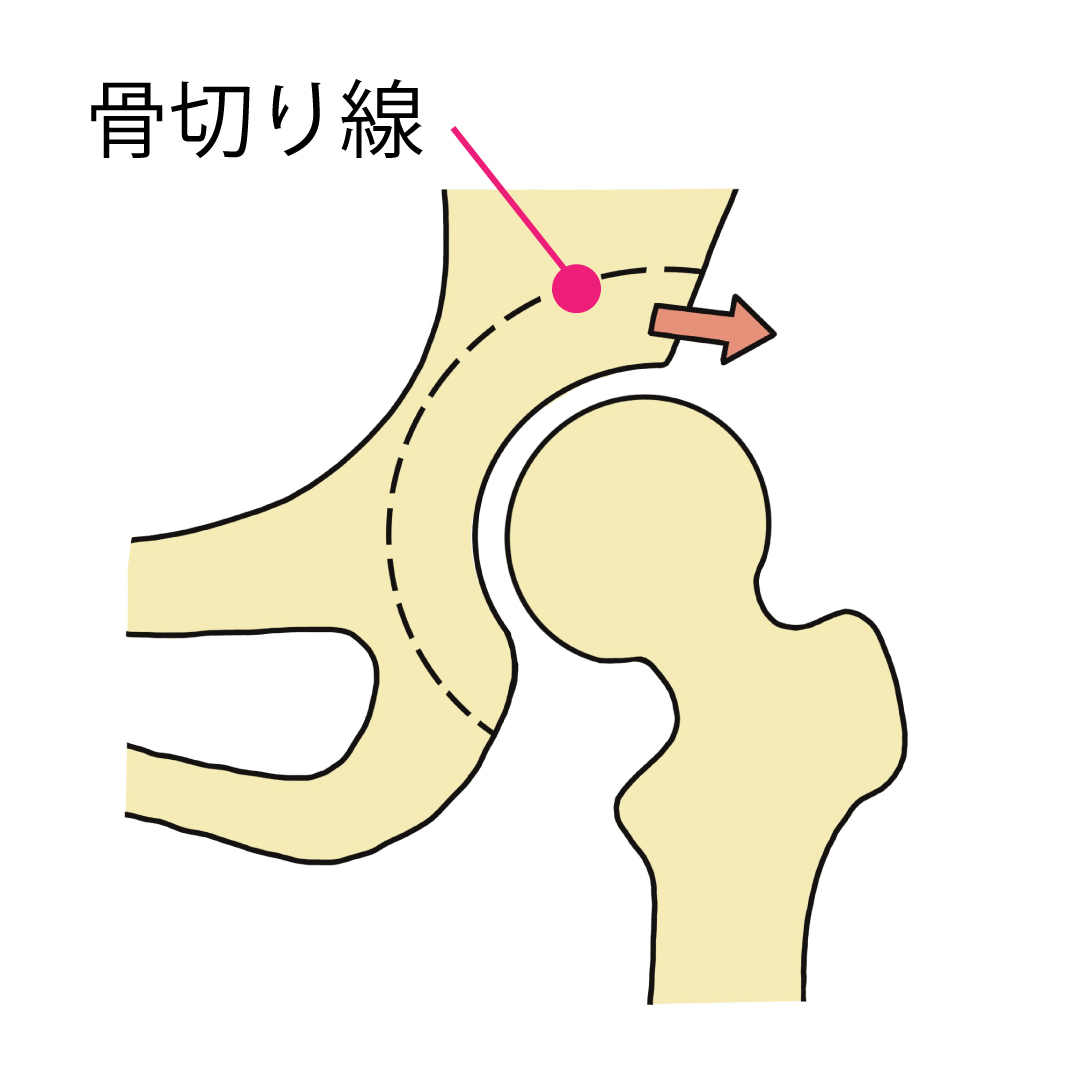 寛骨臼回転骨切り術その１