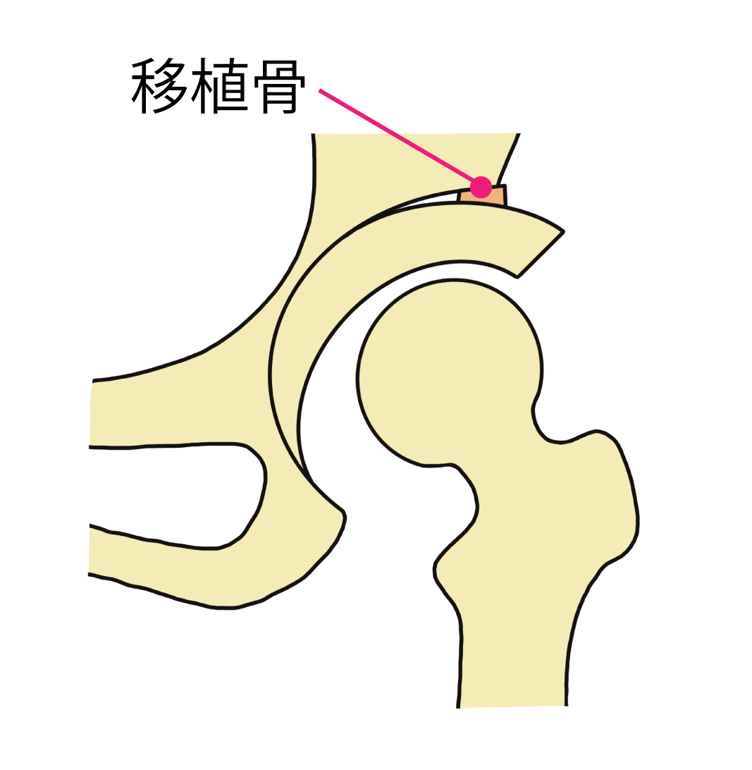 寛骨臼回転骨切り術その2