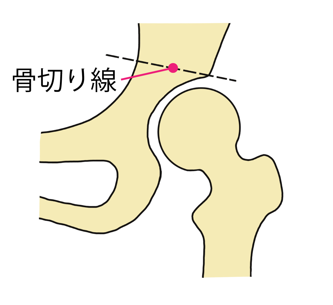 キアリー骨盤骨切り術その1