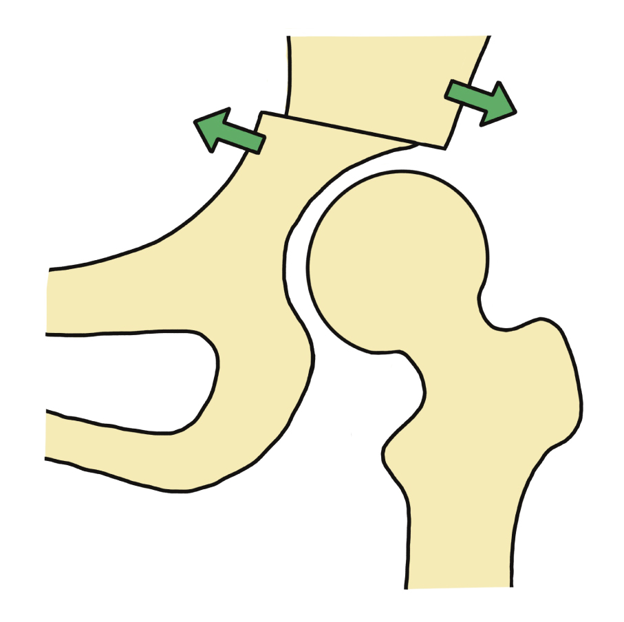 キアリー骨盤骨切り術その2