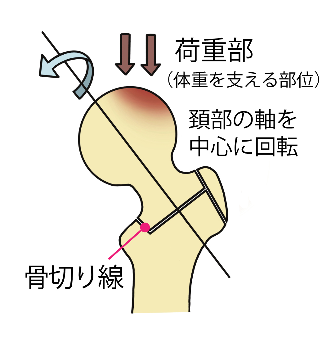 大腿骨頭回転骨切り術その1