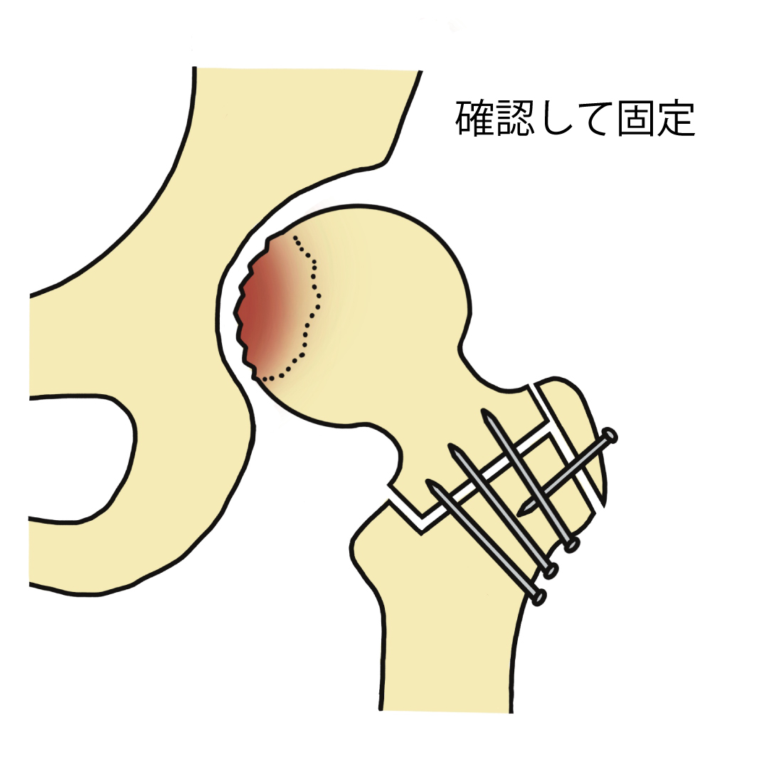 大腿骨頭回転骨切り術その3