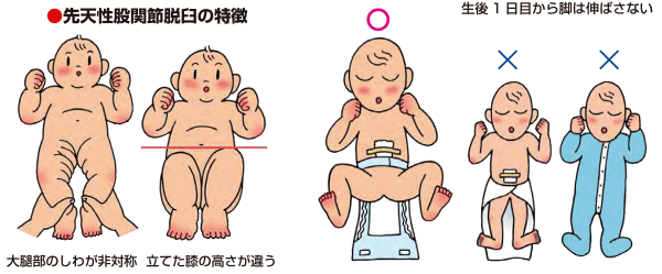 公益財団法人股関節研究振興財団 乳幼児に多い股関節の病気です 発育性股関節脱臼 先天性股関節脱臼