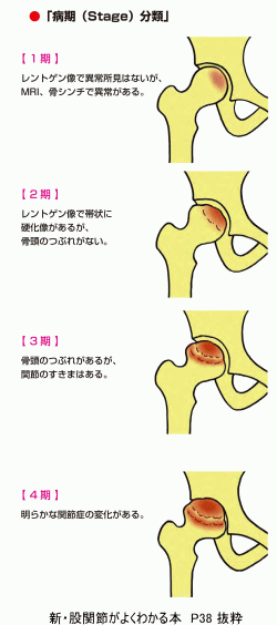 壊死 大腿 骨頭